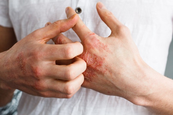 হাতের একজিমা দূর করার উপায়!!