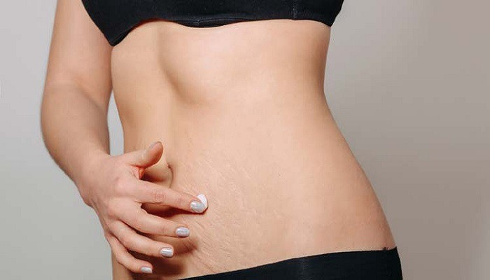 শরীরের ফাটা দাগ দূর করতে ঘরোয়া পদ্ধতি