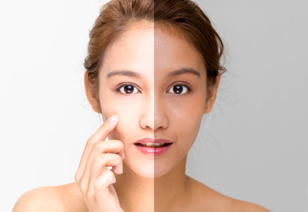 রোদে পোড়া ত্বকের চটজলদি কয়েকটি টিপস্